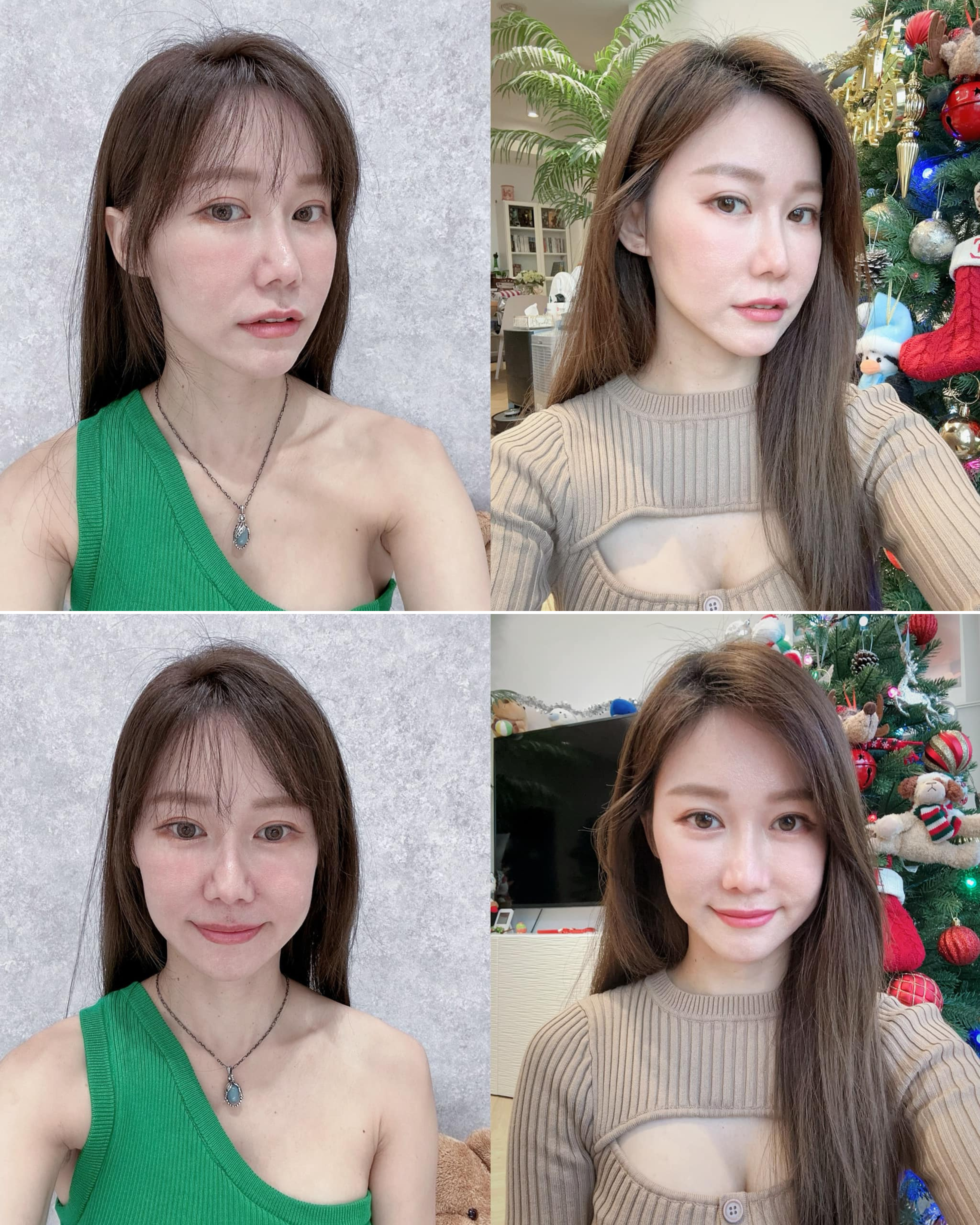 鳳凰電波是不少輕熟女喜愛的療程之一，術後三個月會明顯看到肌膚更加飽滿緊緻